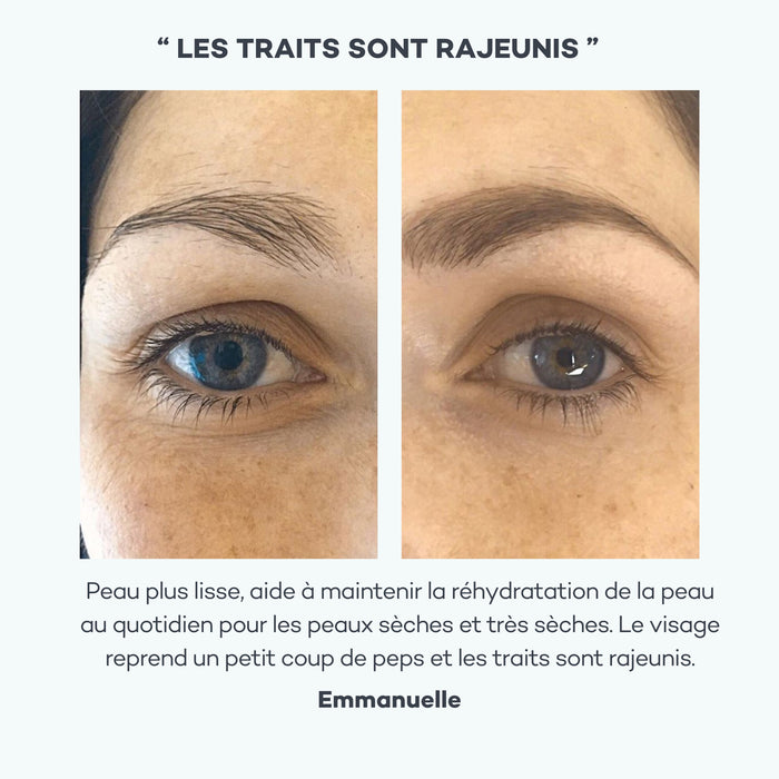 acide hyaluronique