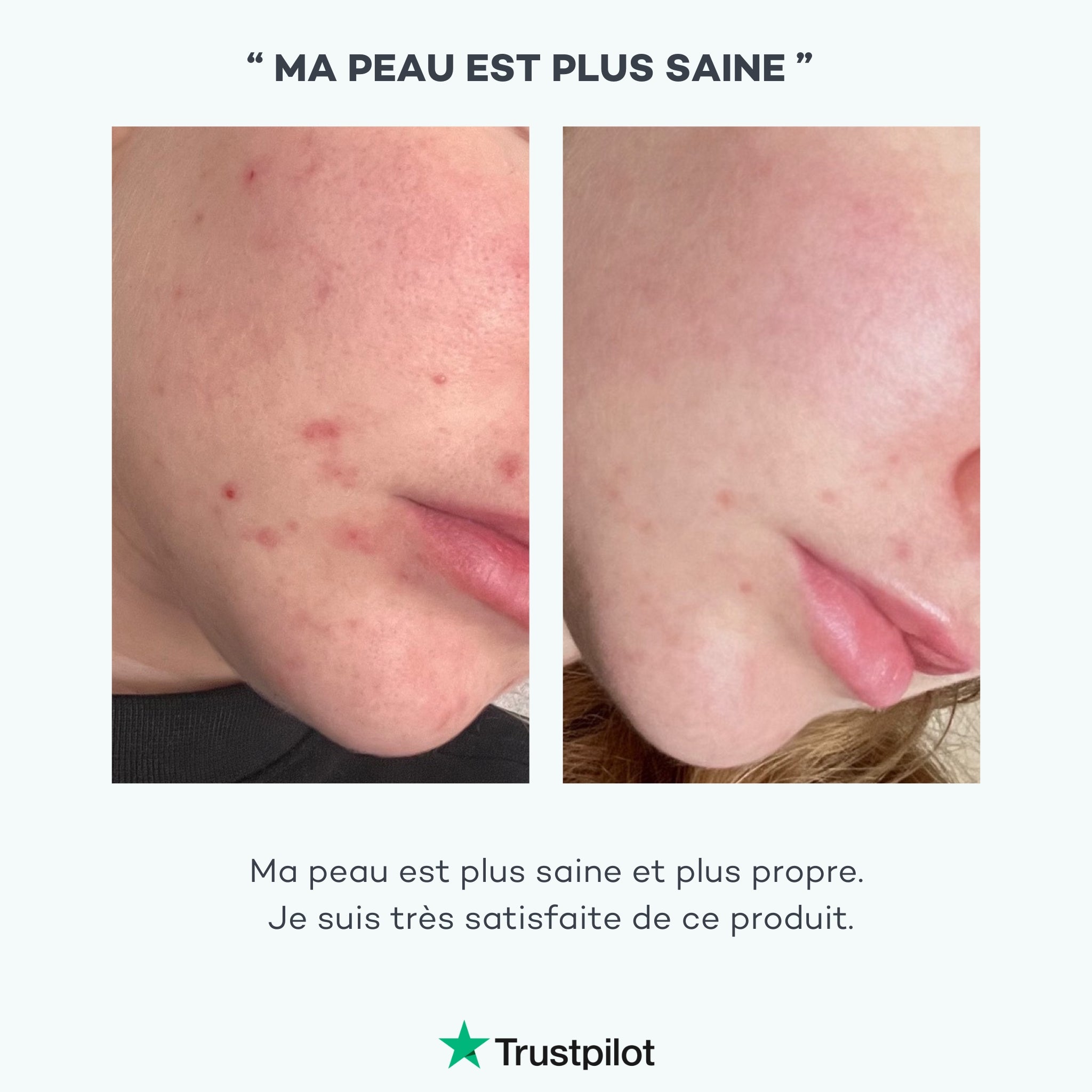 zinc peau