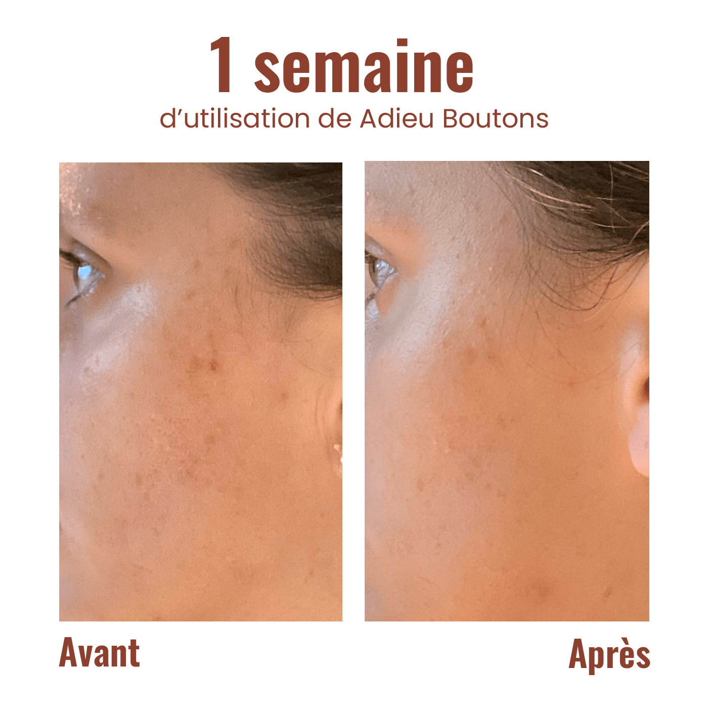 Adieu boutons - Roll-on anti-imperfection