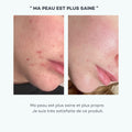 zinc peau