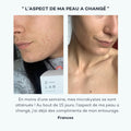 acné avant après