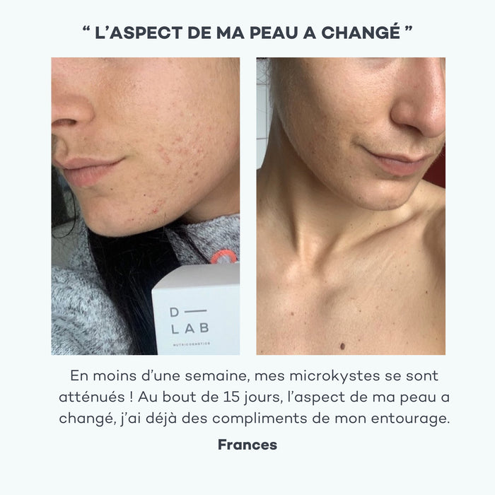 acné avant après