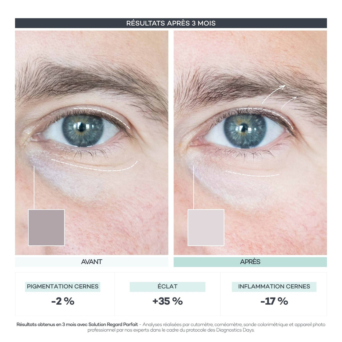 Avant après 3 mois du Shot Regard Parfait : +35% d'éclat, -17% d'inflammation des cernes, -2% de pigmentation des cernes